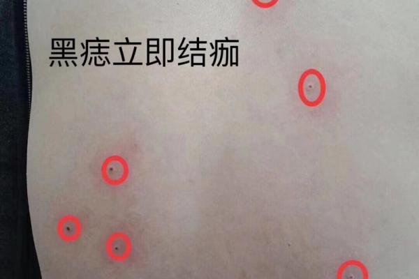 背上痣，是福是祸？