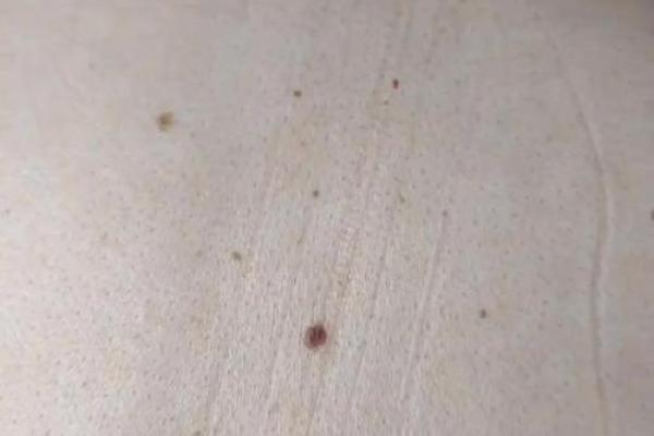 看痣识命运：背部痣相，你的运势如何？