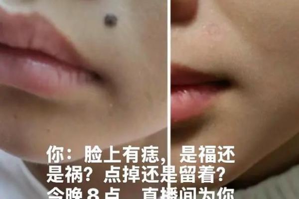 鸡痣揭秘：这是福还是祸？